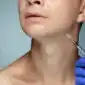 Neck Wrinkles with Botox 85x85