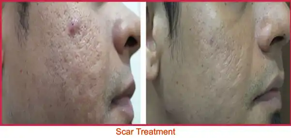 scar-treatment-vile-parle