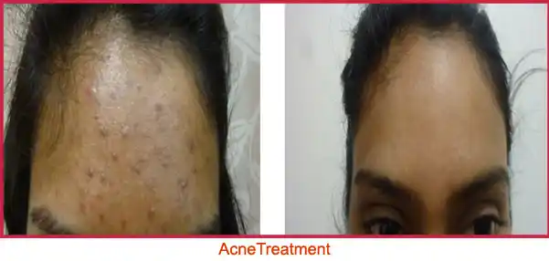 acne-treatment-mumbai