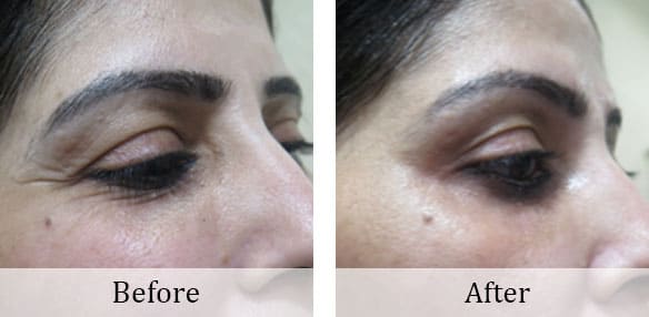 Injectable-treatment (6)