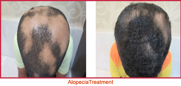 Alopecia Treatment in Mumbai