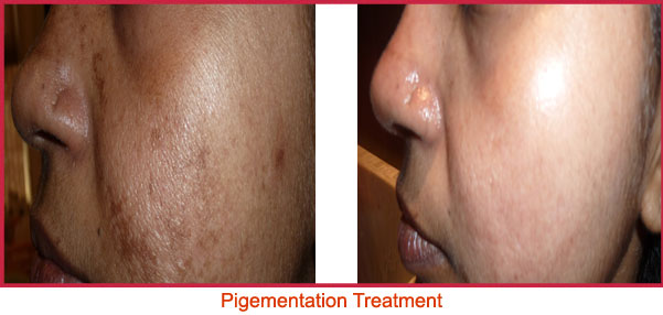 Pigementation Treatment